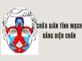 Diện Chẩn chữa giãn Tĩnh Mạch