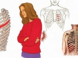 Diện Chẩn chữa đau dây thần kinh liên sườn