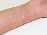 Diện Chẩn chữa dị ứng mề đay
