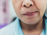 Diện Chẩn chữa liệt dây thần kinh số 7