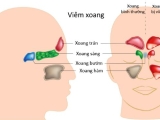Diện Chẩn chữa viêm xoang sàng sau - Giải Pháp Hiệu Quả, An Toàn