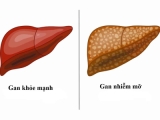 Diện Chẩn chữa gan nhiễm mỡ