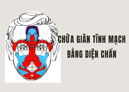 Diện Chẩn chữa giãn Tĩnh Mạch