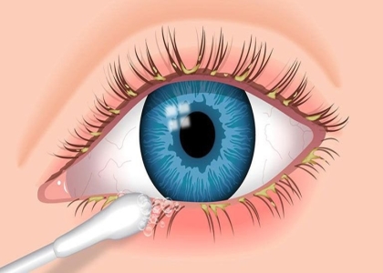 Diện Chẩn chữa ngứa mắt - Giải Pháp Tối Ưu Cho Đôi Mắt Khỏe Mạnh