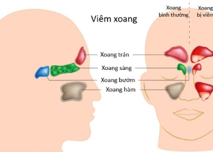 Diện Chẩn chữa viêm xoang sàng sau - Giải Pháp Hiệu Quả, An Toàn